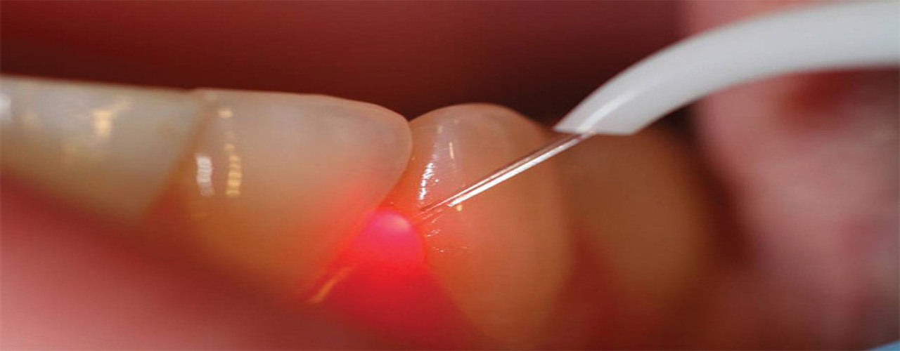 Laser Dental Treatment